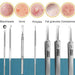 8pcs Ultra-Fine Acne Needle Tool Set Beauty Care